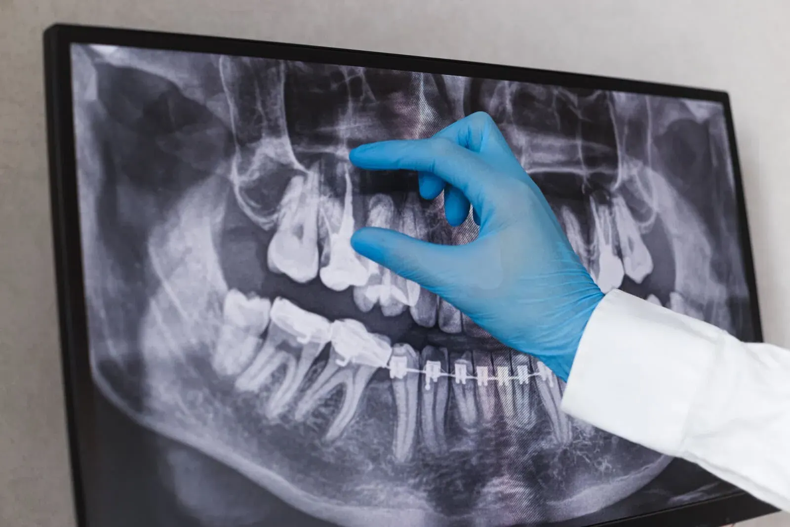 Gentle Root Canal Treatment Right Here in Newkirk, OK