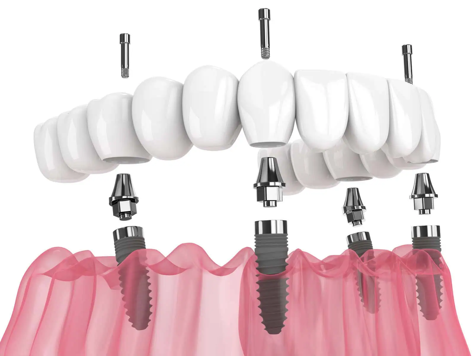 All-on-4 Implants in Newkirk, OK — Full Arch Smile Restoration