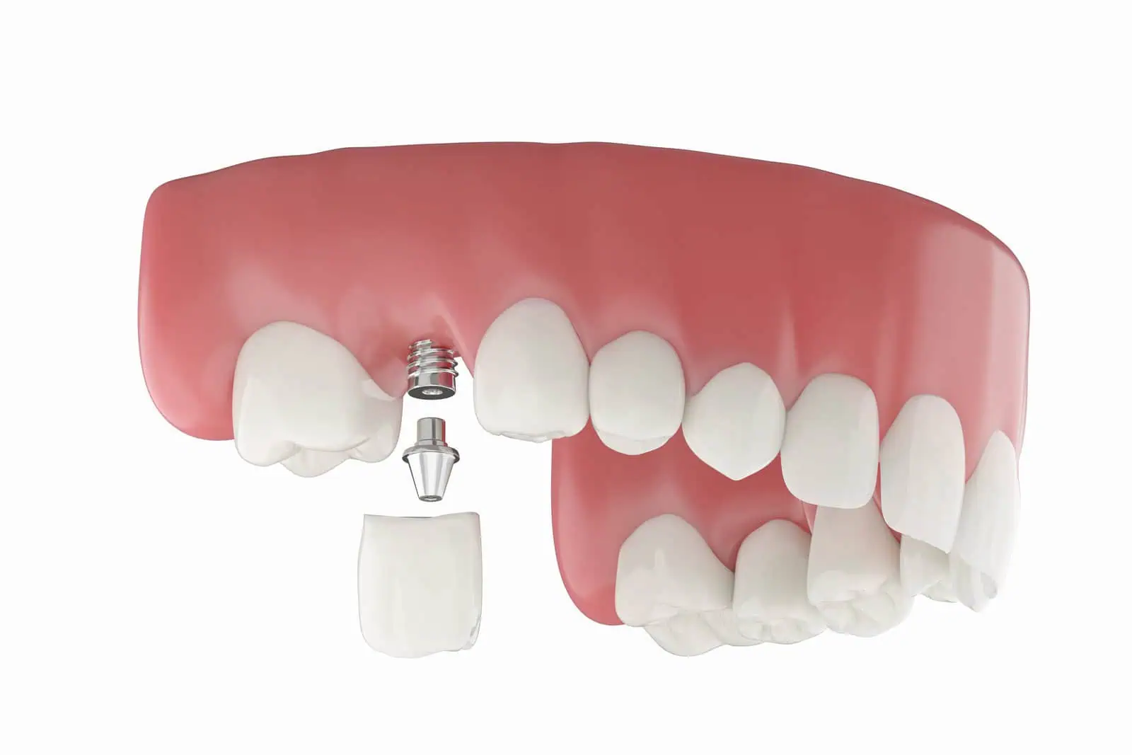 Dental Implants in Newkirk, OK — Restore Your Smile