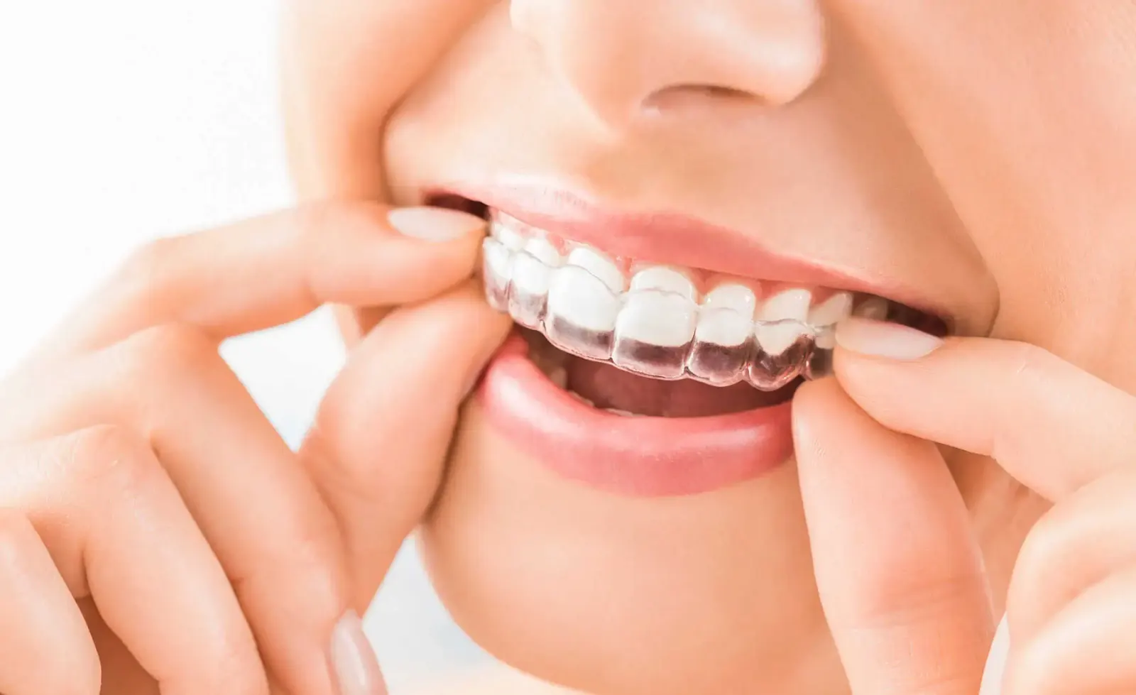 Clear Aligner Treatment with Invisalign in Newkirk, OK