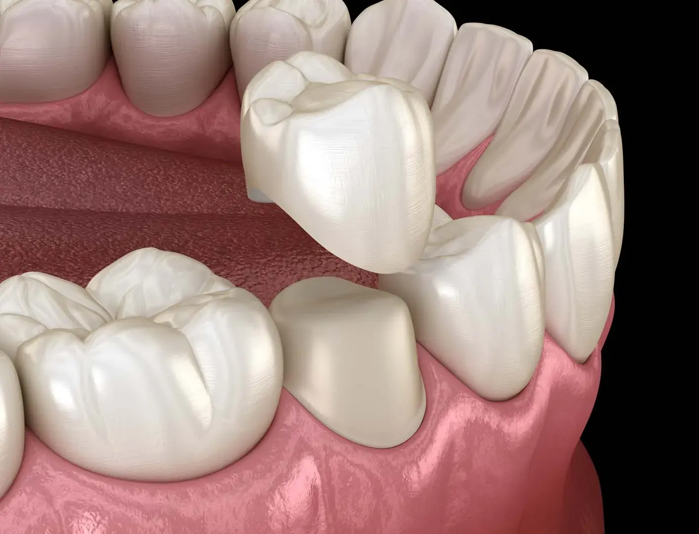 Tooth restoration with a tooth-coloured crown
