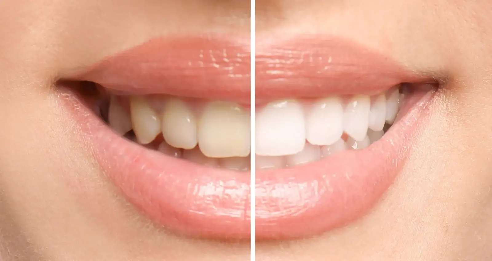 Cosmetic and smile design treatments