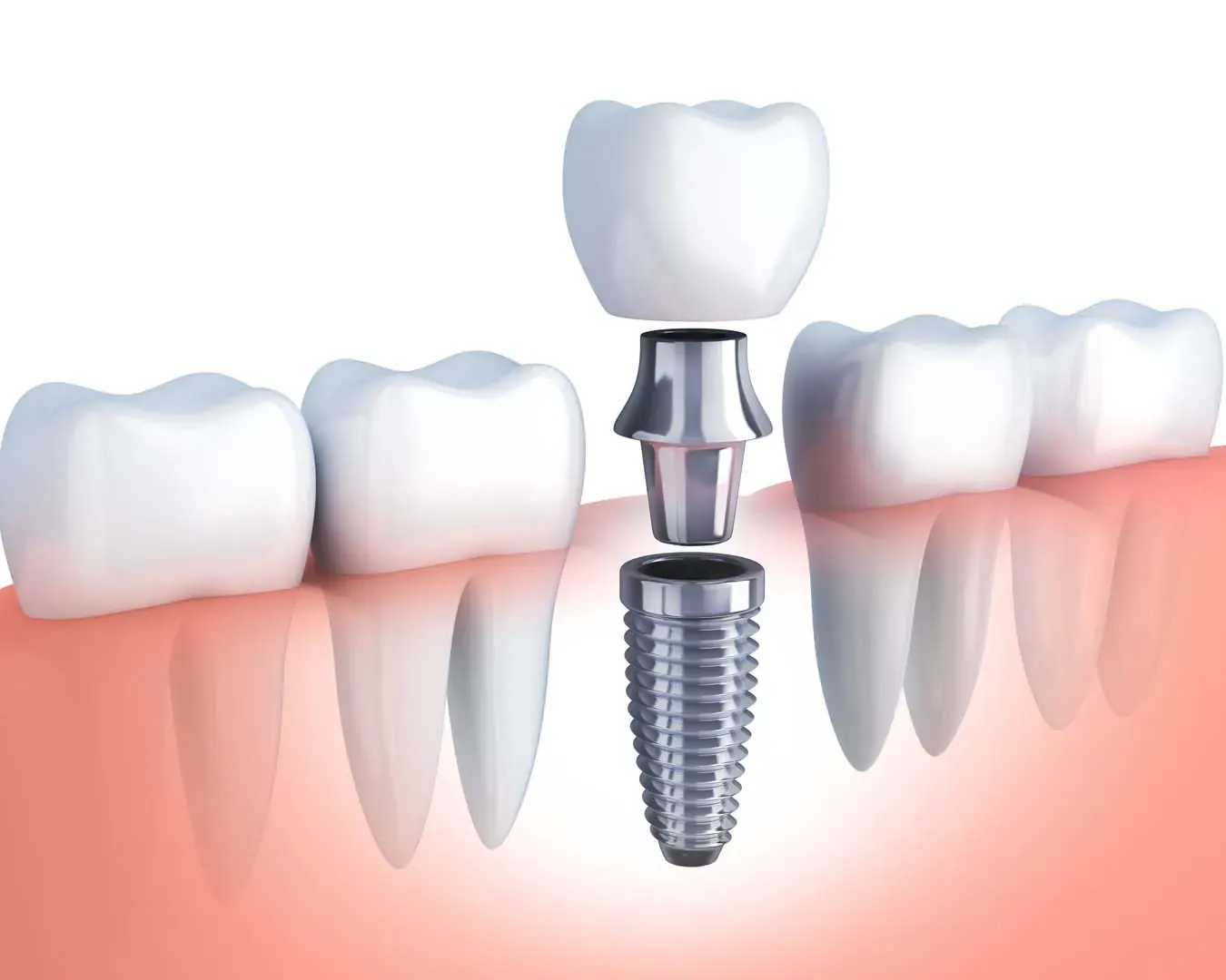 Restorative dentistry and tooth replacement